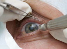 Cirurgia que altera cor do olho tem uso restrito para pessoas cegas
