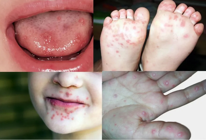 Doença é caracterizada pelo surgimento de erupções vesiculares nas mãos, pés e na mucosa oral