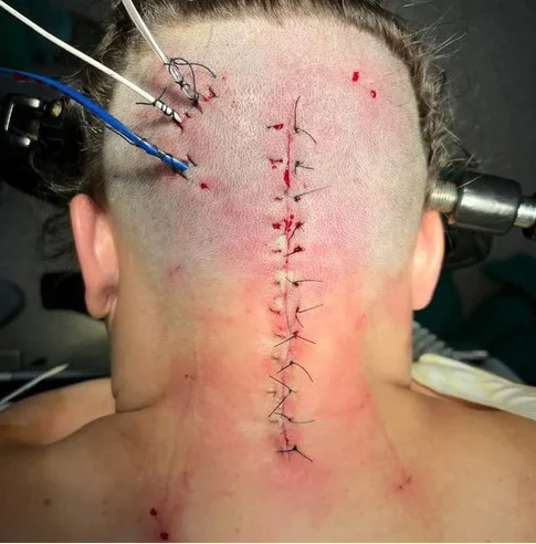 Dois anos e meio de luta: Professora enfrenta 10 cirurgias, Dor Cr&ocirc;nica e alto custo  por tratamento Neurol&oacute;gico.