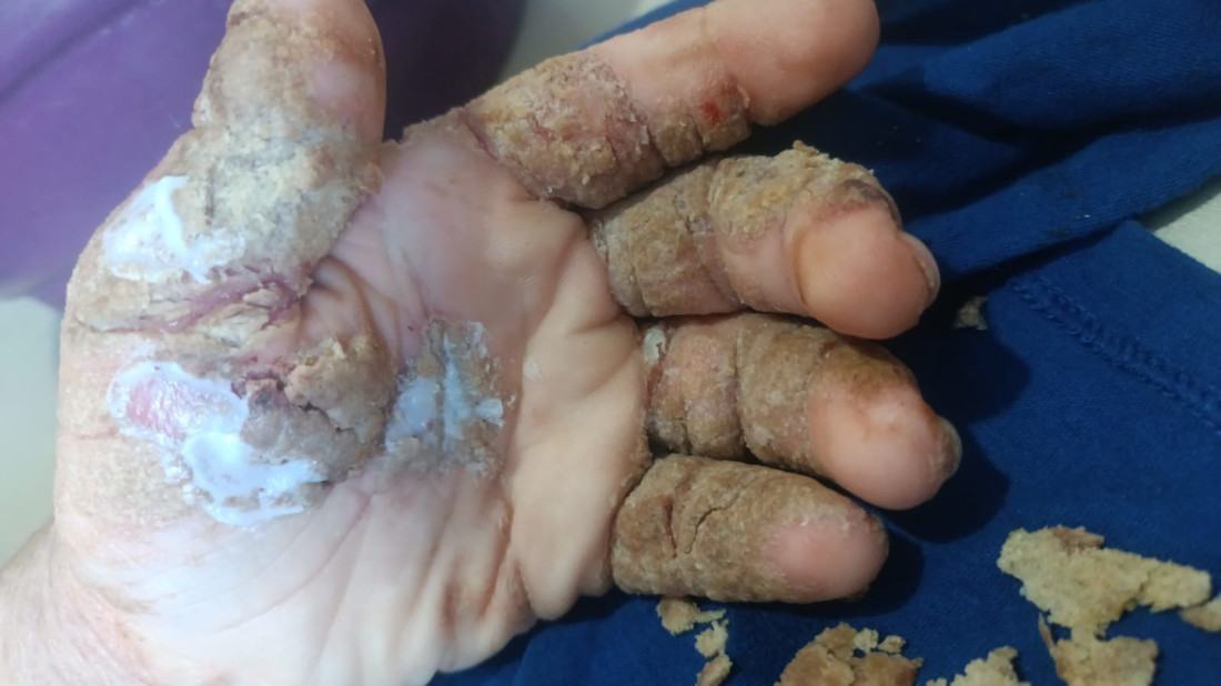 Com feridas graves e dores constantes, jovem do bairro &Aacute;gua Verde precisa de bi&oacute;psia urgente para voltar a ter qualidade de vida