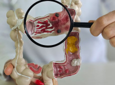 Em 13 anos, doen&ccedil;a inflamat&oacute;ria intestinal cresce 5 vezes no Brasil